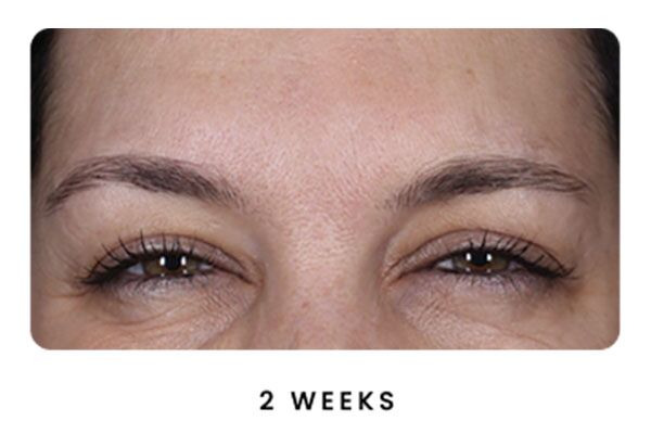 Botox result 2 Weeks