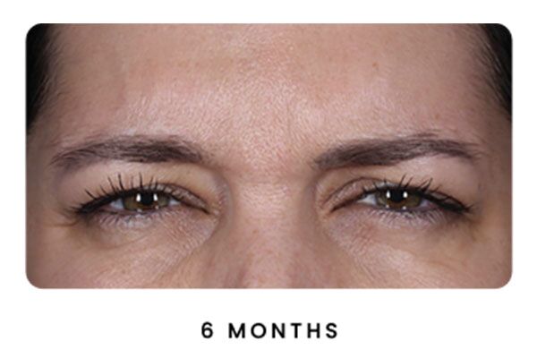 Botox result 6 Months