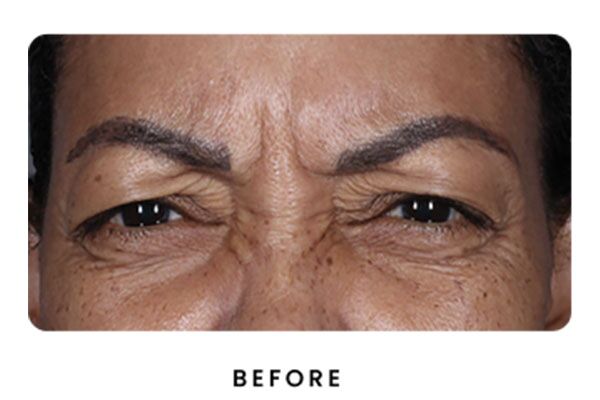Botox result Before